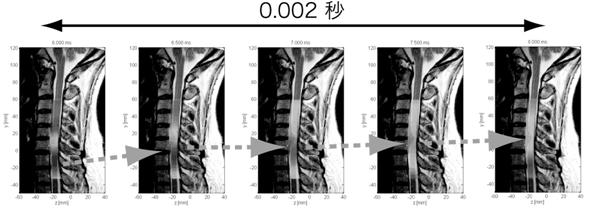 脊髄磁場計測による頚部脊髄機能イメージングの例