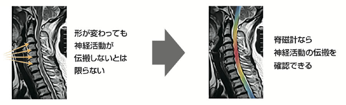 脊磁計による神経活動可視化のイメージ